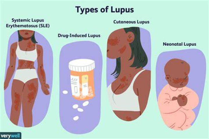 Pin on Lupus