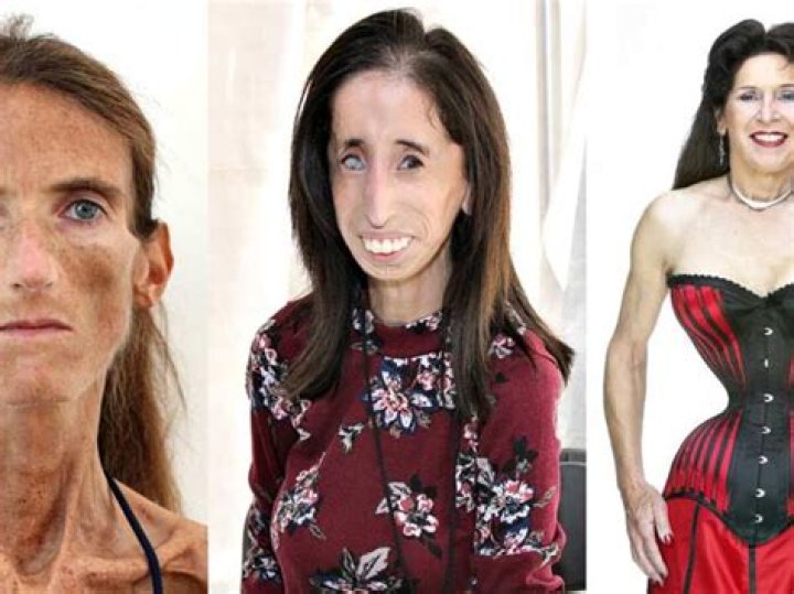 The Skinniest Person: Exploring The Fascinating Lives And Stories Behind Extreme Thinness